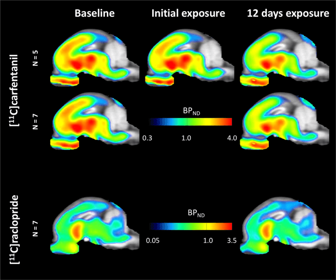 Sucrose intake lowers μ opioid and dopamine D2 3 receptor  