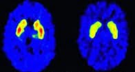 ตัวรับโดปามีนที่ลดลงใน striatum อยู่ด้านหลังติดสื่อลามก